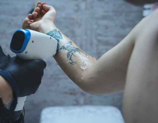Tattoo Removal: Is It Safer Than Getting a Tattoo?
